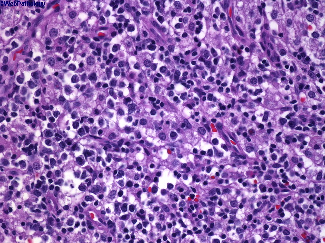 Extranodal NK-T-cell Lymphoma_Nasal2.jpg